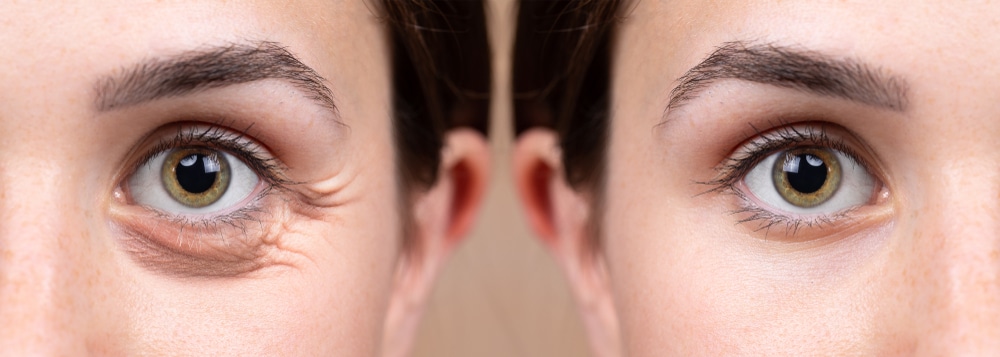 Blepharoplasty | Plastic Surgery Specialists of South Florida